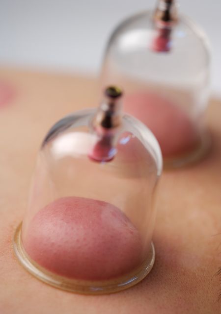 cupping-tecnica-de-ventosas_01