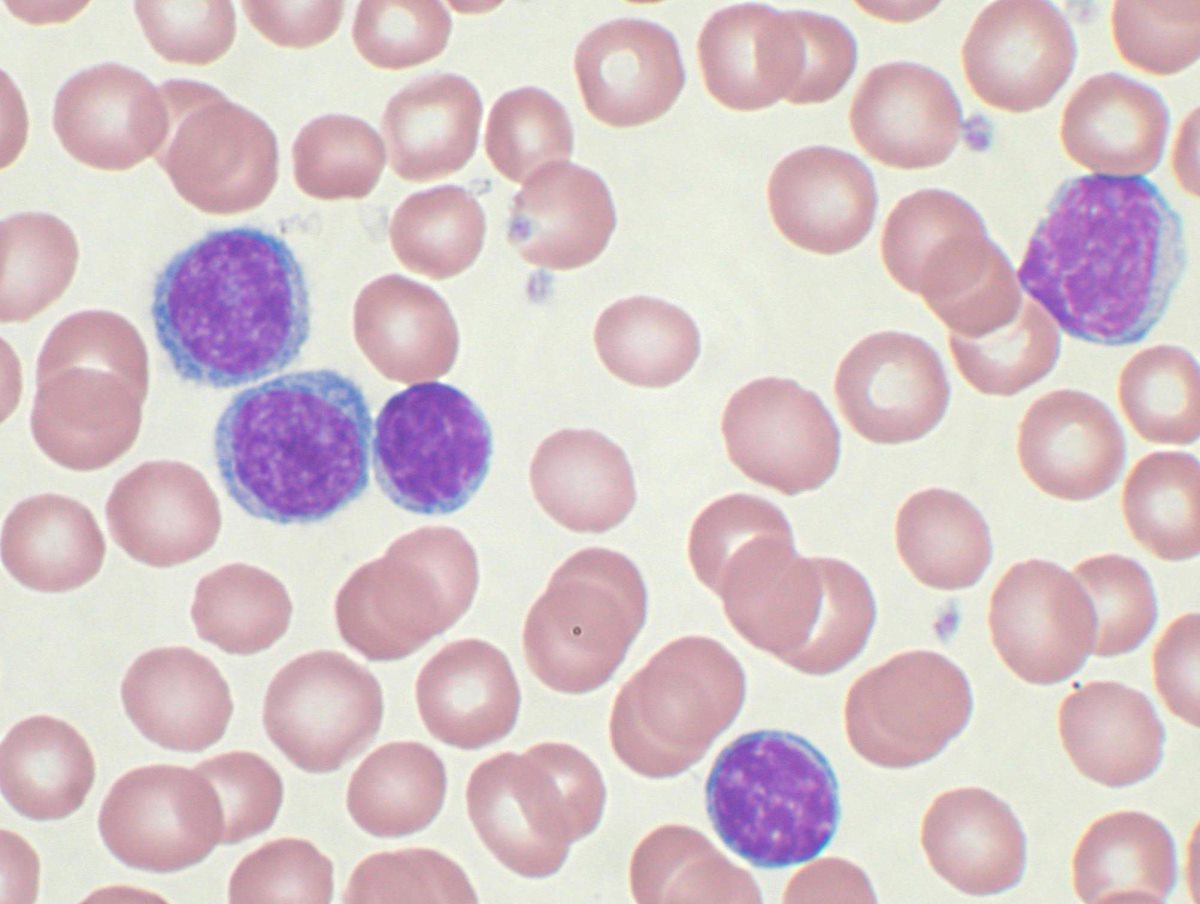 leucemia-linfoide-cronica