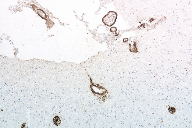 Depósitos da proteína beta-amiloide no córtex fronta. Foto: Reprodução / Nature