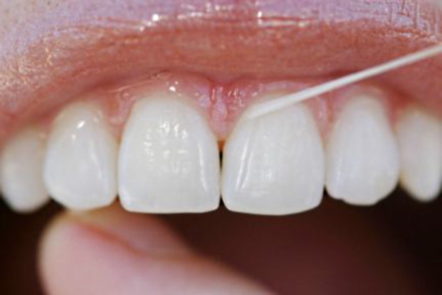 Usar fio dental de maneira errada pode prejudicar a saÃºde
