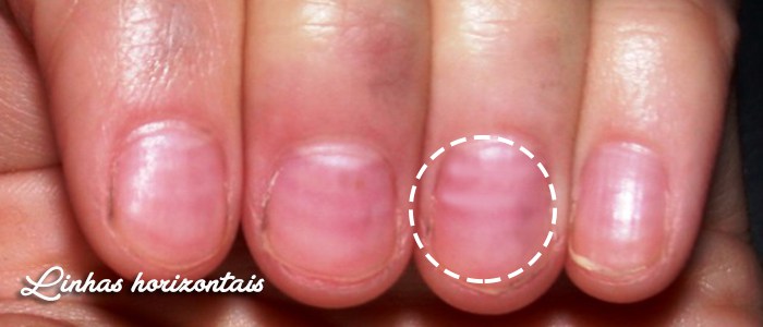 identificar-doencas-atraves-das-unhas_04