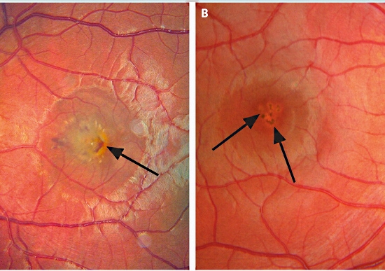 lesao-causada-por-laser-na-retina