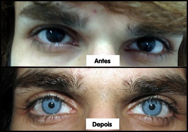 Paciente que realizou um implante de um disco de material plástico para mudar a cor dos olhos de castanho para azul. 