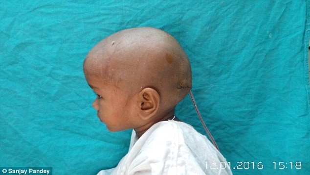 tumor-na-cabeca-indiana-4-anos_02
