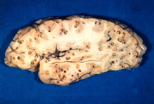 Cérebro humano infestado por cisticercos.