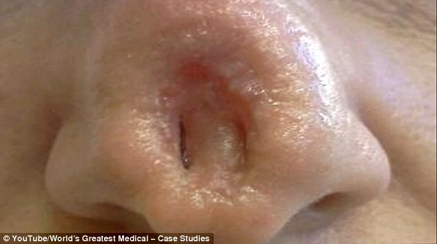 cancer-no-nariz-apos-pomada-fitoterapica-Cansema