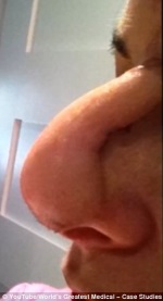 cancer-no-nariz-apos-pomada-fitoterapica-Cansema_01