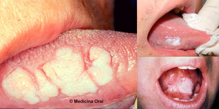 leucoplasia-oral