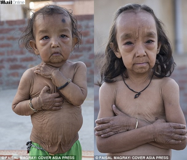 progeria-na-India_02