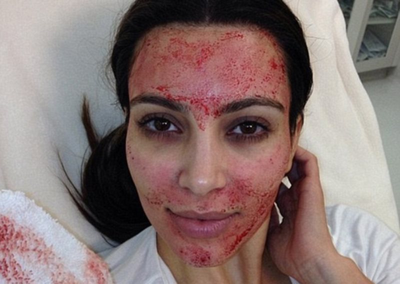 Kim Kardashian utiliza o conceito de PRP para outros procedimentos com o Dr. O. 