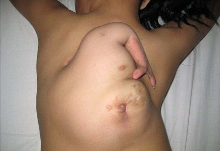 O caso de fetus in fetu ocorrido em 2012.