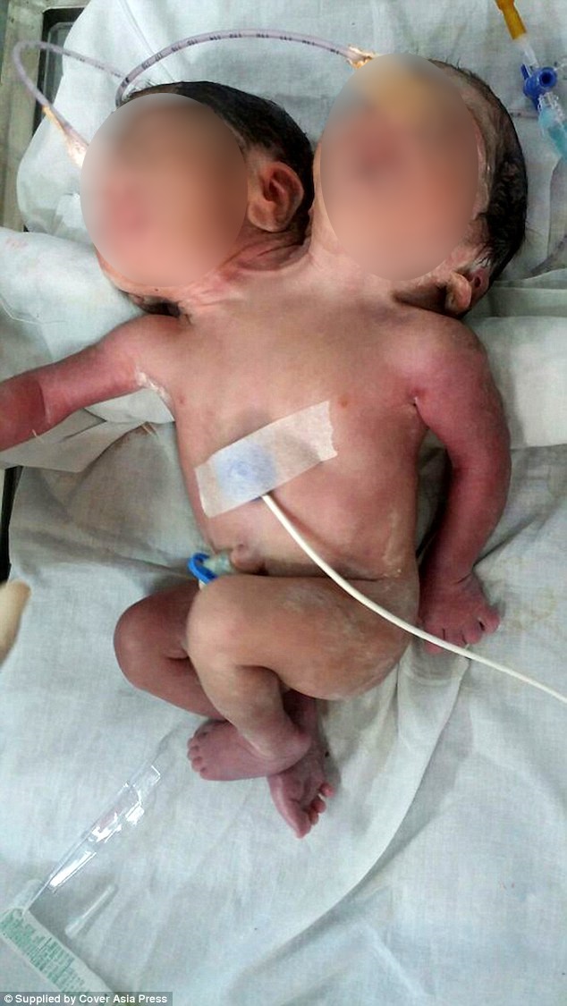 bebe-de-duas-cabecas_03_
