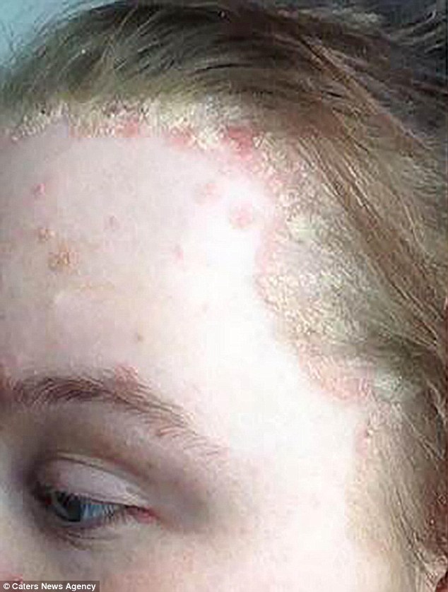 jovem-sofre-com-psoriase_3