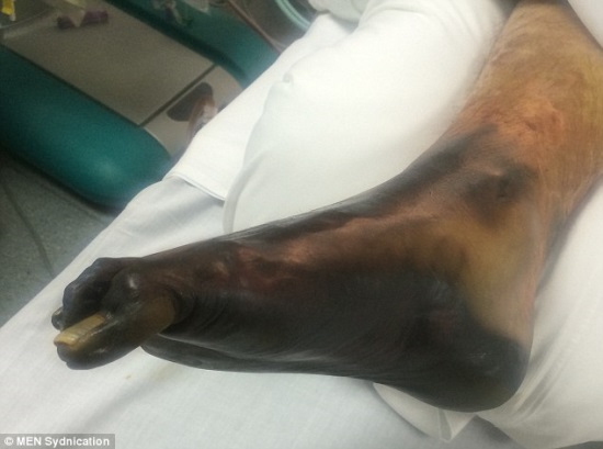 homem-precisa-amputar_4