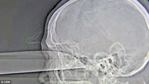 radiografias-mostram-lamina_4