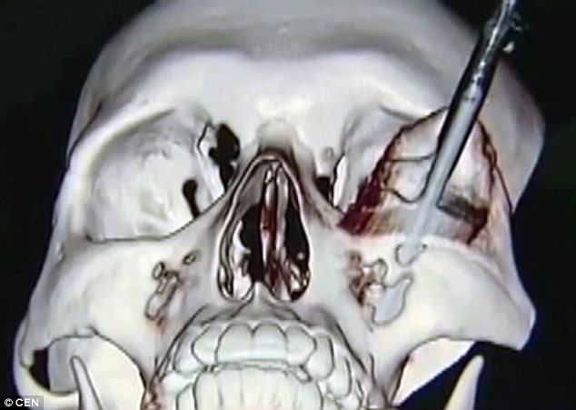 radiografias-mostram-lamina_5