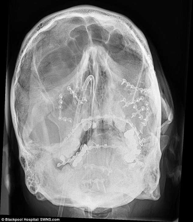 radiografias-motociclista_01