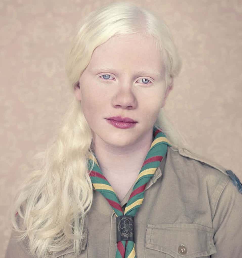 albinismo-1
