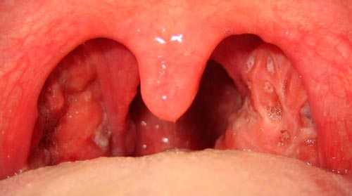 mononucleose-infecciosa-13