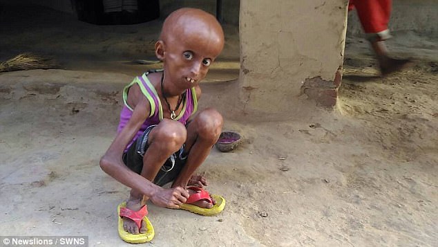 progeria-3