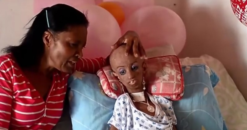 progeria_02
