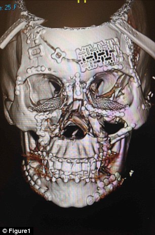 tomografias-cranio-esmagado_2