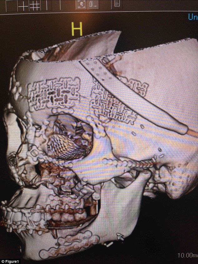 tomografias-cranio-esmagado_3