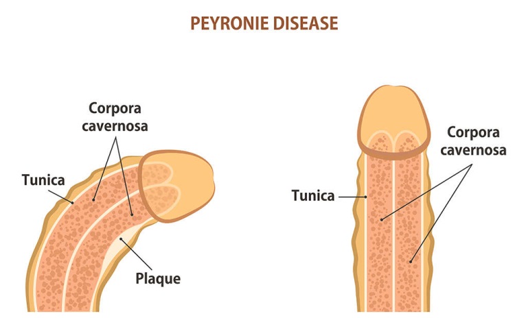 doenca-de-Peyrone
