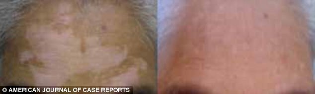 homeopatia-vitiligo_3