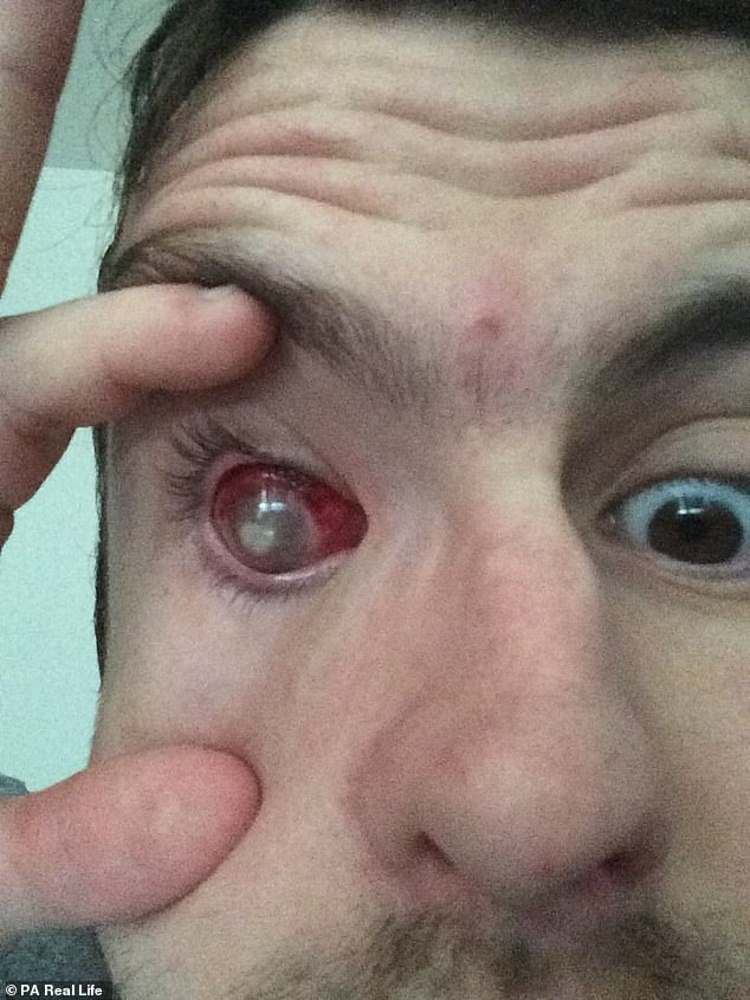 homem fica cego após tomar banho usando lentes de contato 
