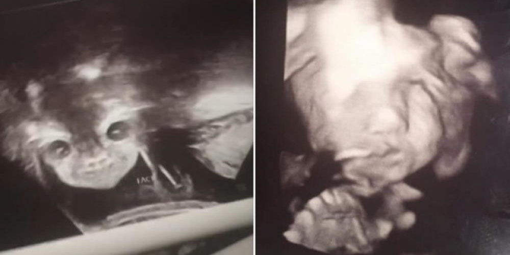 Mãe tomou susto ao ver rosto de bebê no útero após ultrassom