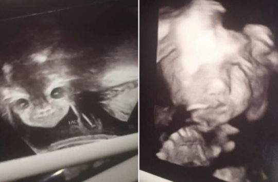 Mãe tomou susto ao ver rosto de bebê no útero após ultrassom