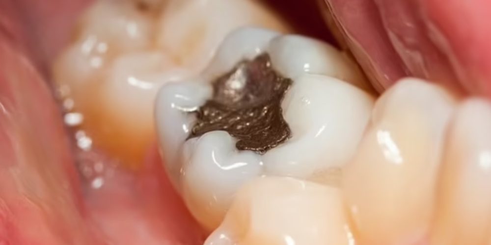 Amálgama: Europa quer proibir as famosas restaurações dentárias de mercúrio devido à toxicidade; Reino Unido é contra