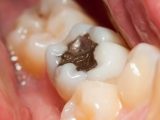 Amálgama: Europa quer proibir as famosas restaurações dentárias de mercúrio devido à toxicidade; Reino Unido é contra