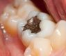 Amálgama: Europa quer proibir as famosas restaurações dentárias de mercúrio devido à toxicidade; Reino Unido é contra